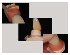 歯周組織コントロール